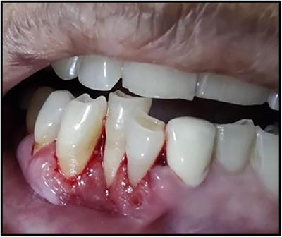 Unusual localized gingival redness: a case report